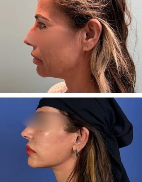 Lifting Facial y Cuello caso 4 — antes y después